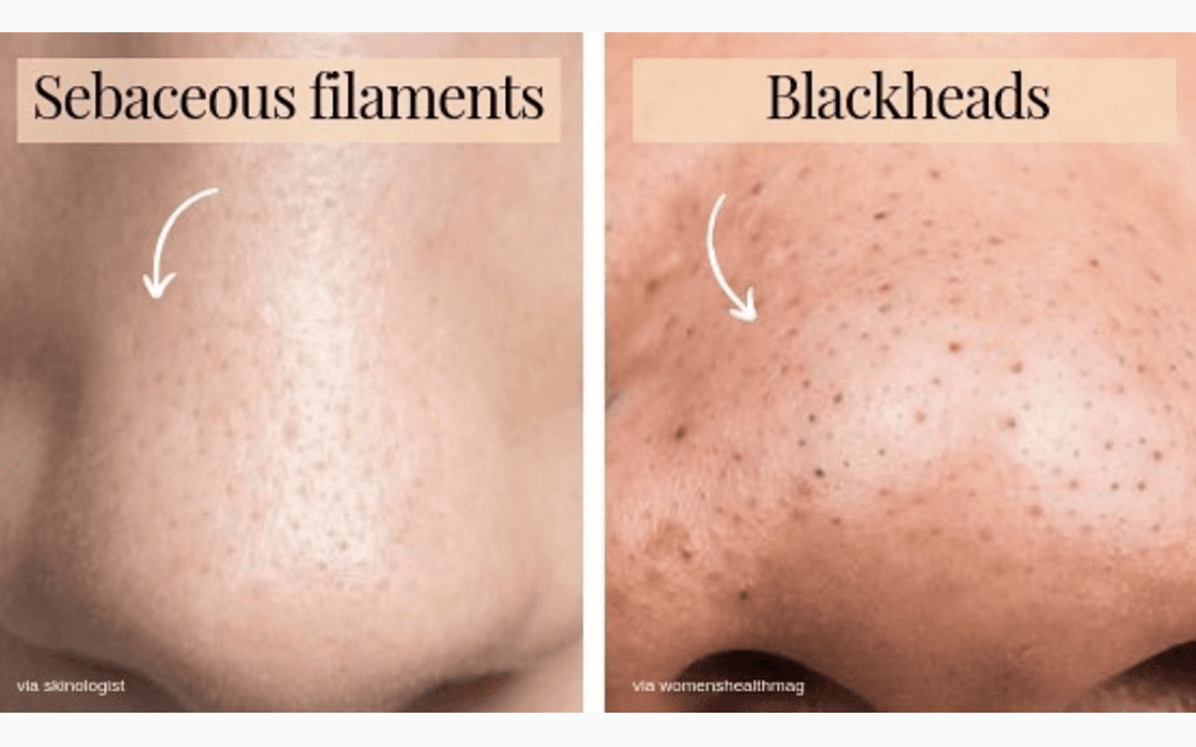 Introducing New Services: Vascular Lesions & Sebaceous Filaments ...