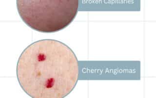 Broken Capillaries + Cherry Angiomas + Sebaceous Filaments