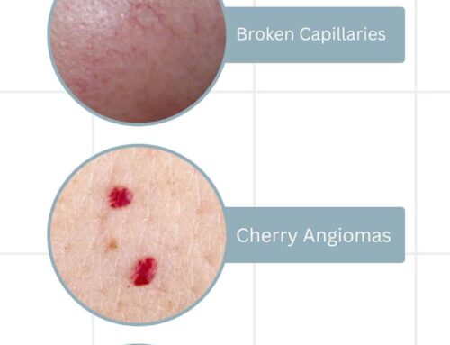 Introducing New Services: Vascular Lesions & Sebaceous Filaments