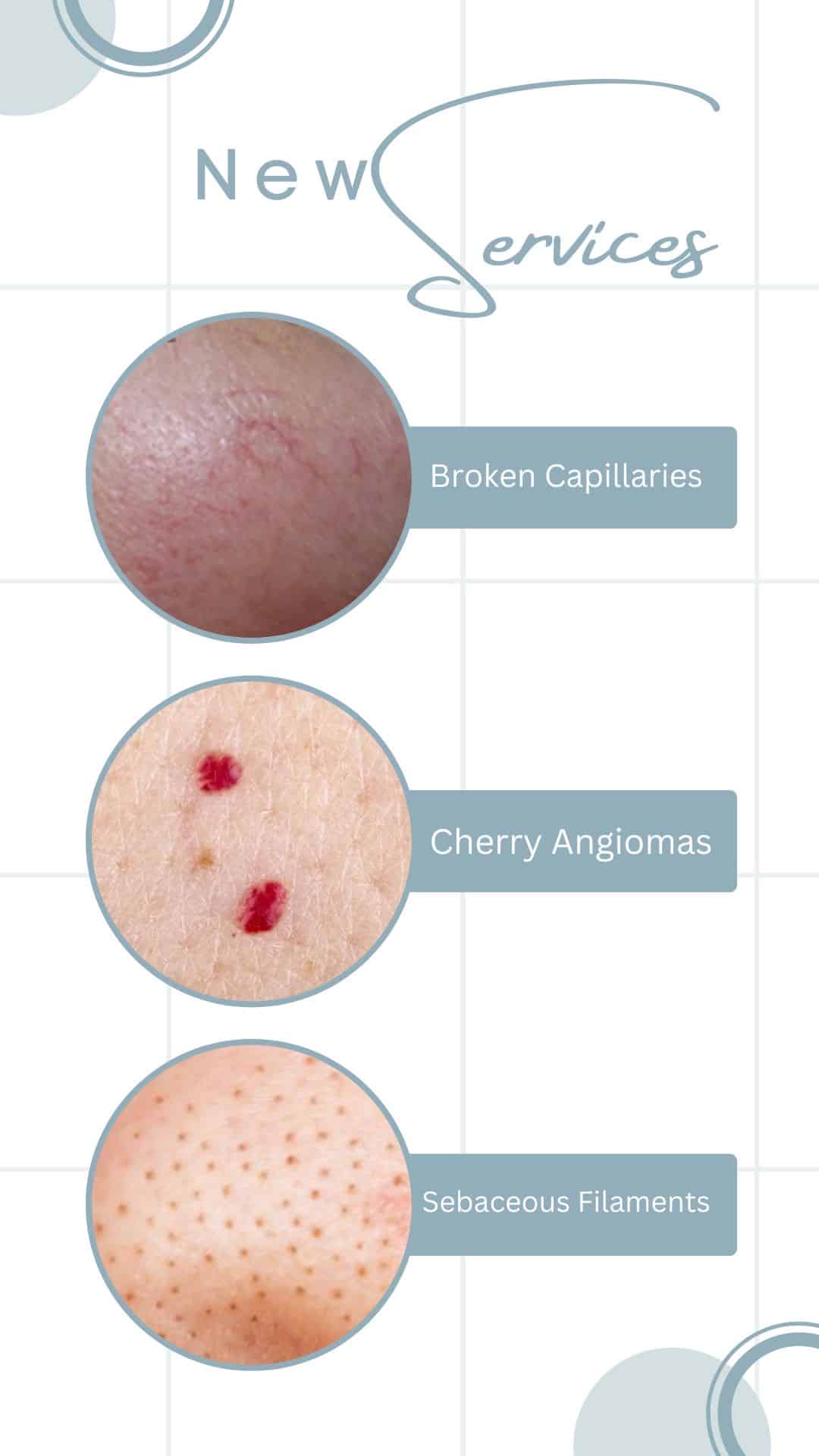 Broken Capillaries + Cherry Angiomas + Sebaceous Filaments