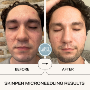 Before and After SkinPen Microneedling Chicago 