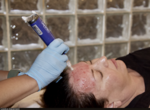 Best SkinPen Microneedling Chicago