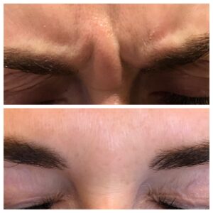 First Time Client Botox Specials Chicago