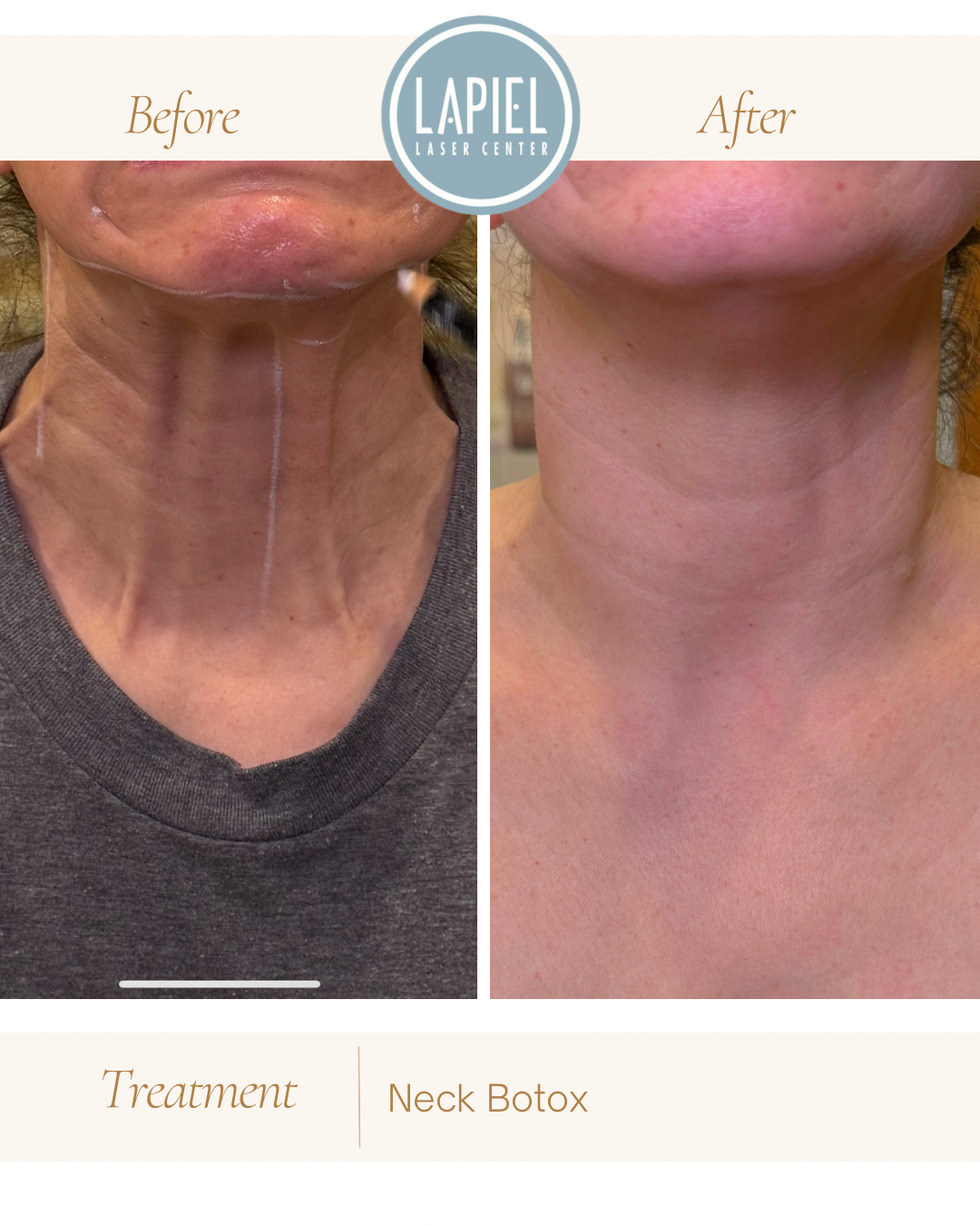 Neck Botox Before and After