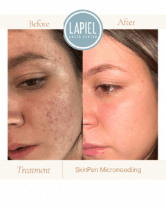 SkinPen for Brides Chicago