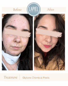 Chicago Chemical Peel Results Acne 