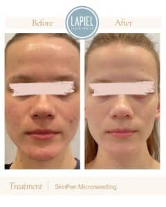 Acne Scarring Treatment 