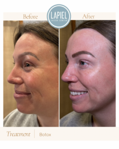 Botox Special Chicago 