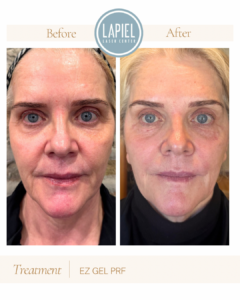 Under eye EZ Gel Results