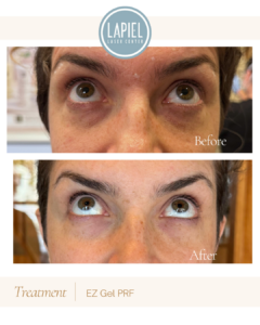 EZ Gel Natural Filler Chicago