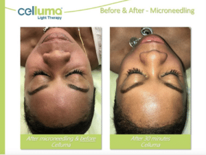 Chicago LED Light Therapy 