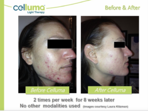 Chicago Acne Specialists Red Light