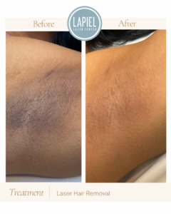 Chicago Laser Hair Removal Results