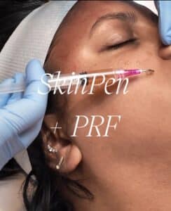 Where to get PRF with Mirconeedling in Chicago