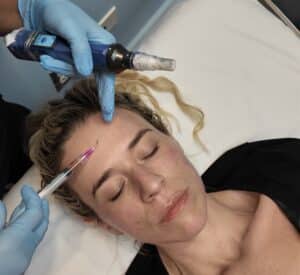 Best SkinPen Results Chicago